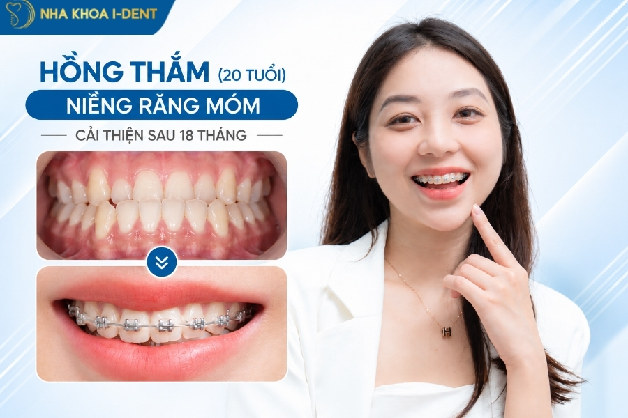 niềng răng móm mất bao nhiêu tiền - Nha khoa I-Dent
