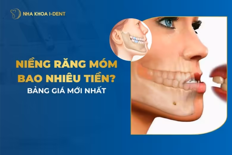 niềng răng móm bao nhiêu tiền