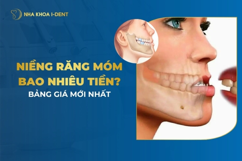 niềng răng móm bao nhiêu tiền