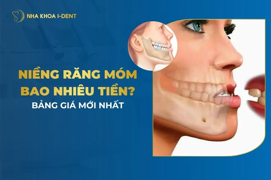 niềng răng móm bao nhiêu tiền