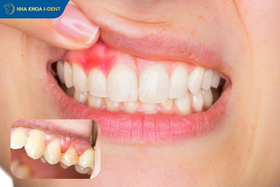 viêm nướu răng làm sao hết