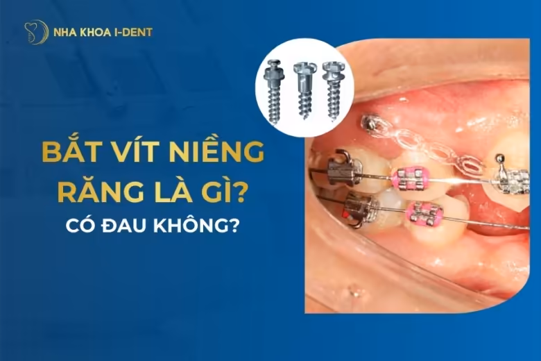 bắt vít niềng răng