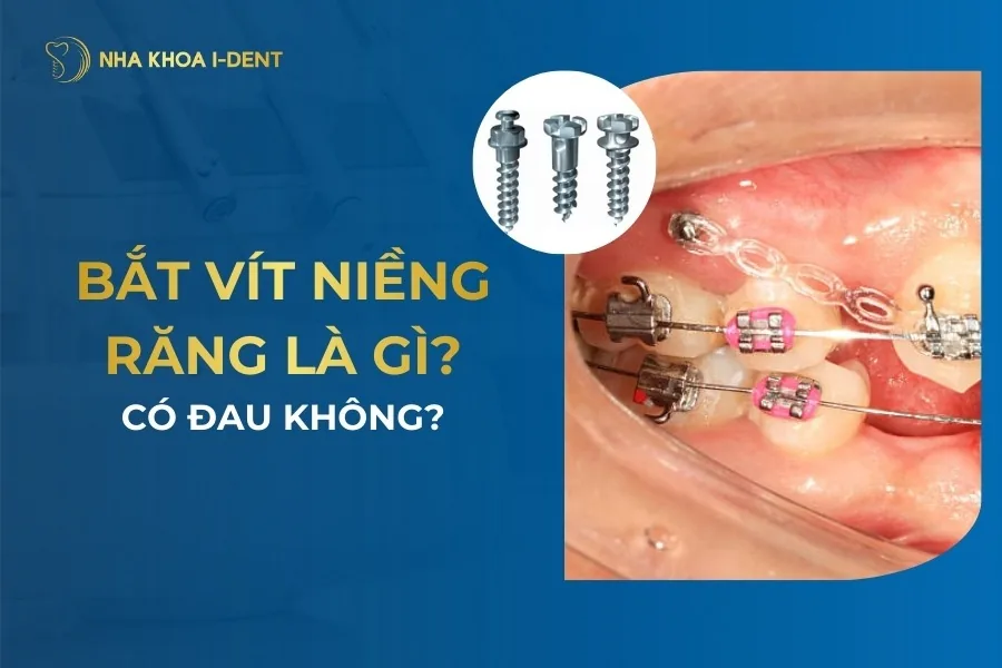 bắt vít niềng răng