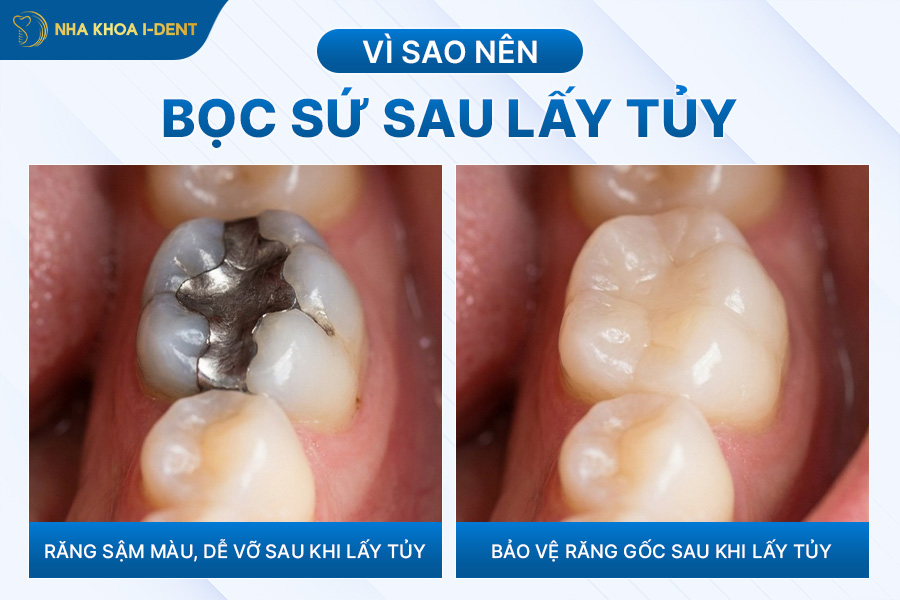 bọc răng sứ sau khi lấy tủy bao nhiêu tiền