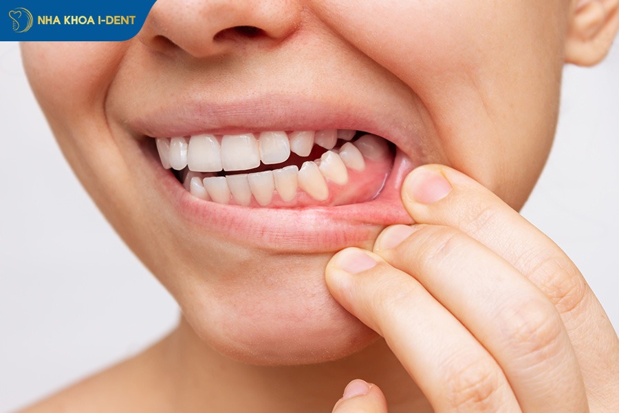 cảm giác sau khi bọc răng sứ