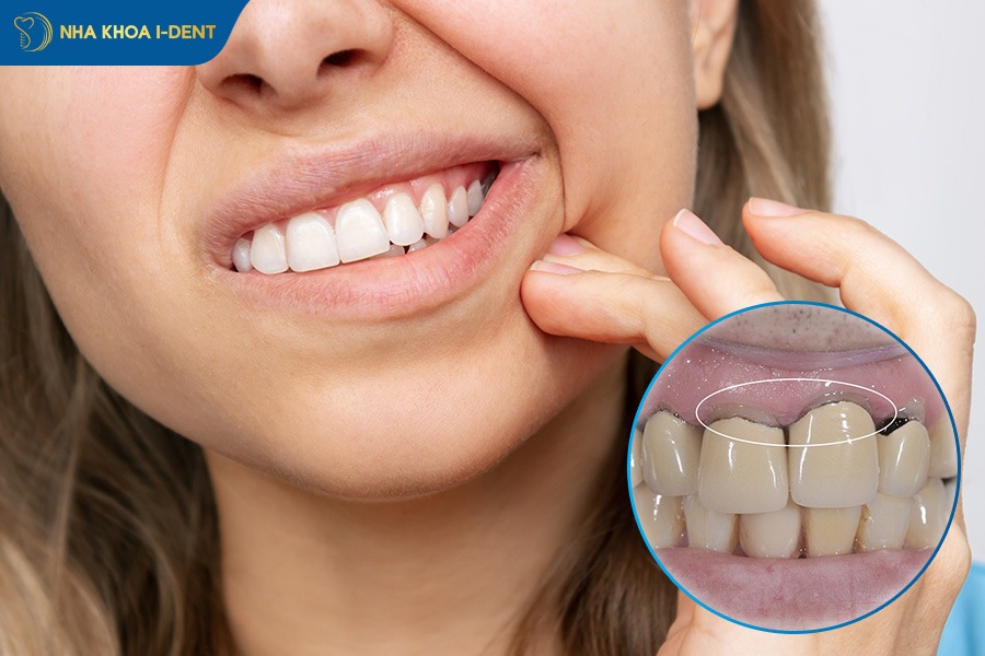 cảm giác sau khi gắn răng sứ