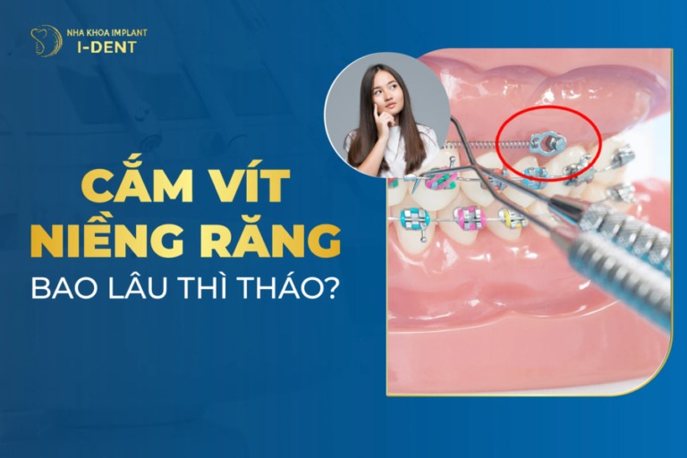 cắm vít niềng răng bao lâu thì tháo