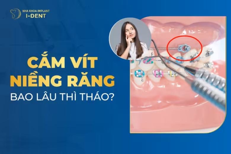 cắm vít niềng răng bao lâu thì tháo