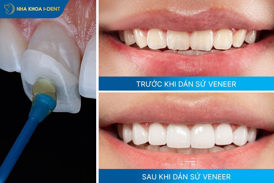 dán sứ veneer không mài răng