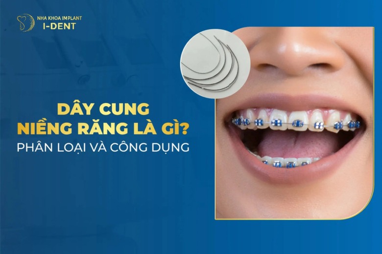 Dây Cung Niềng Răng: Các Loại Và Công Dụng