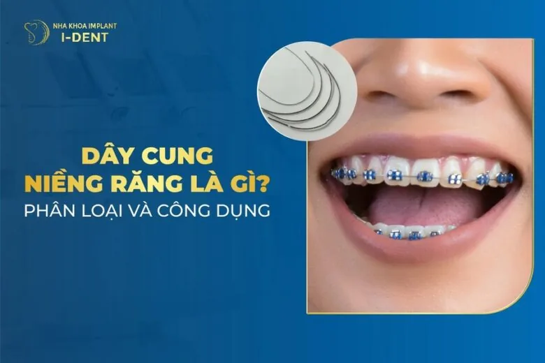dây cung niềng răng