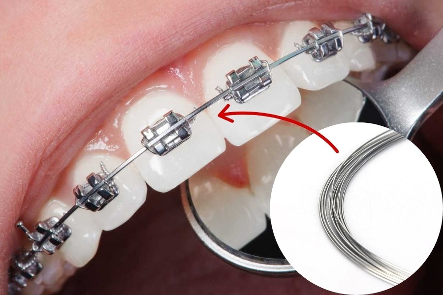 dây thép niềng răng