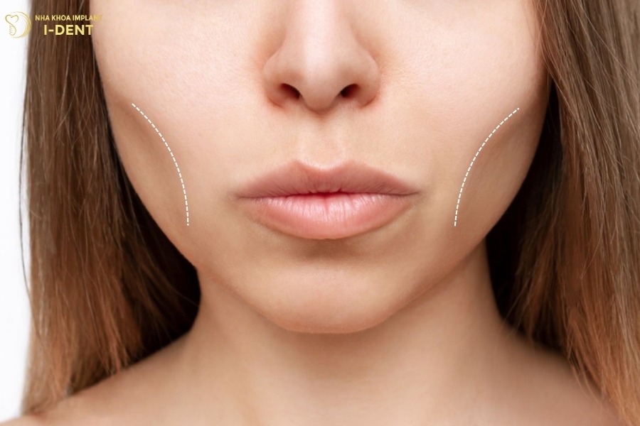 hóp má khi niềng răng