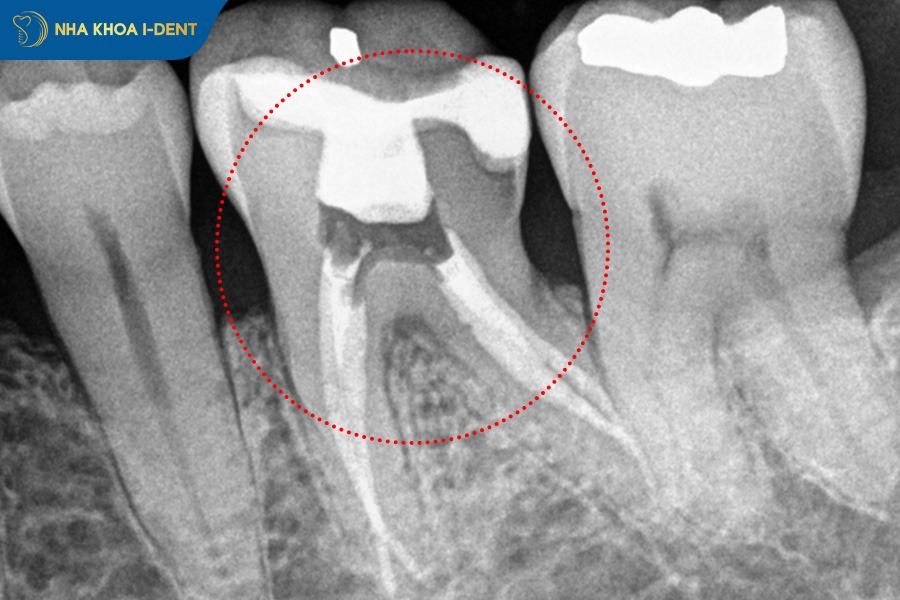 làm răng sứ có niềng răng được không