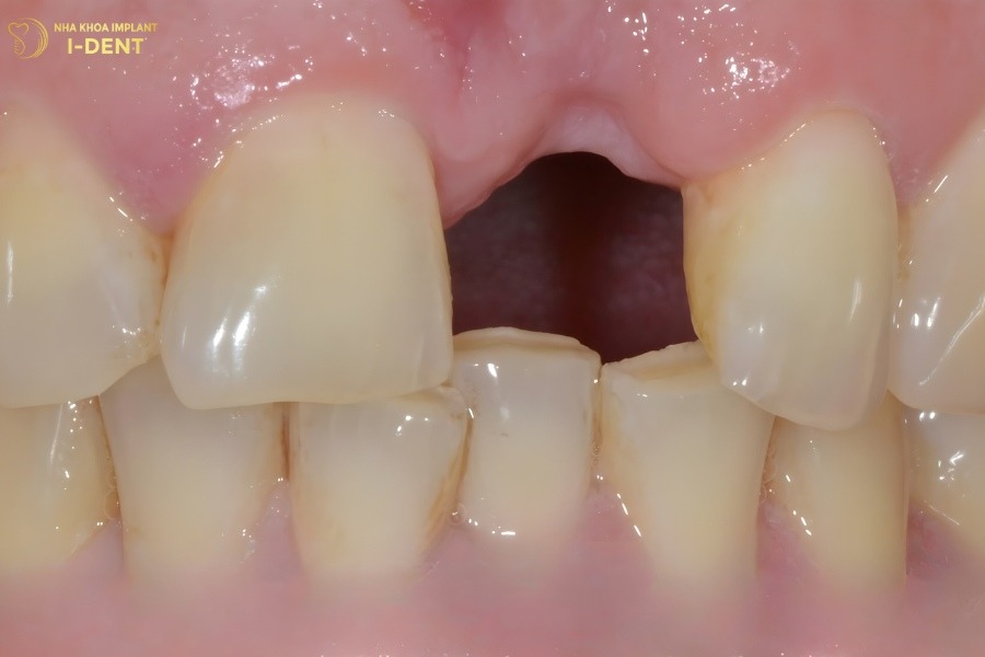 cách khắc phục hóp má khi niềng răng