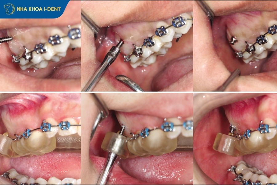 niềng răng bắt vít