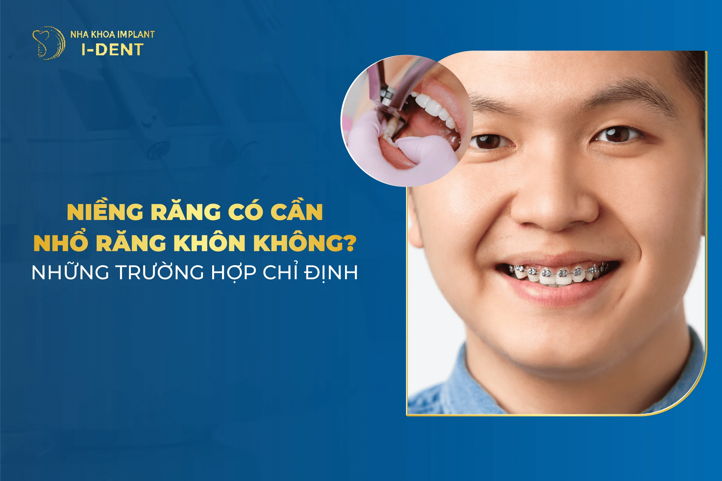 Niềng Răng Có Cần Nhổ Răng Khôn Không? Những Trường Hợp Chỉ Định