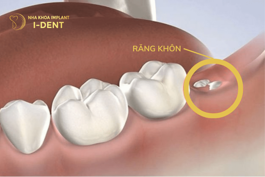Niềng răng nhổ răng không không phụ thuộc vào chỉ định nha sĩ