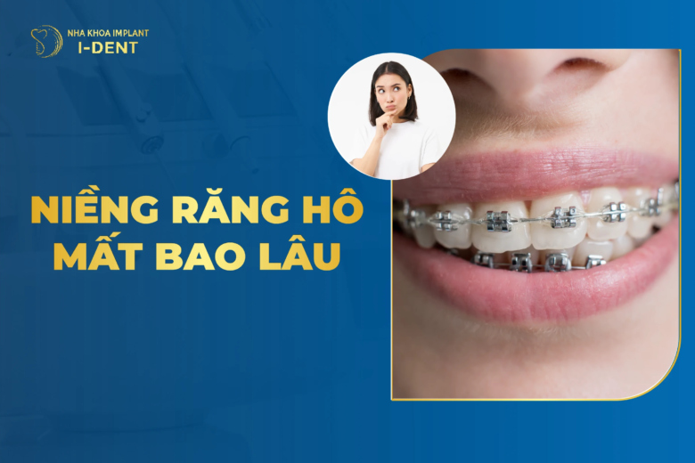 Niềng Răng Hô Nhẹ Mất Bao Lâu? Khi Nào Có Hiệu Quả?