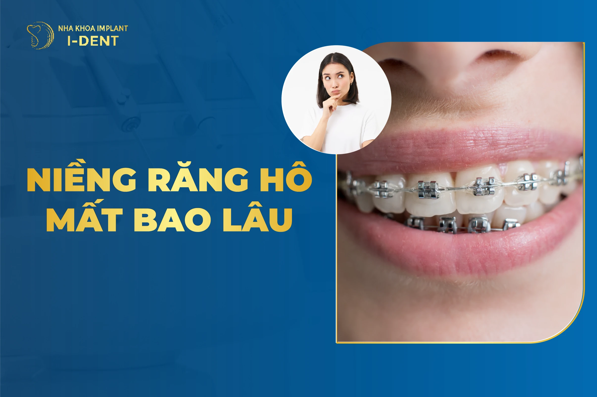 Niềng Răng Hô Nhẹ Mất Bao Lâu? Khi Nào Có Hiệu Quả?