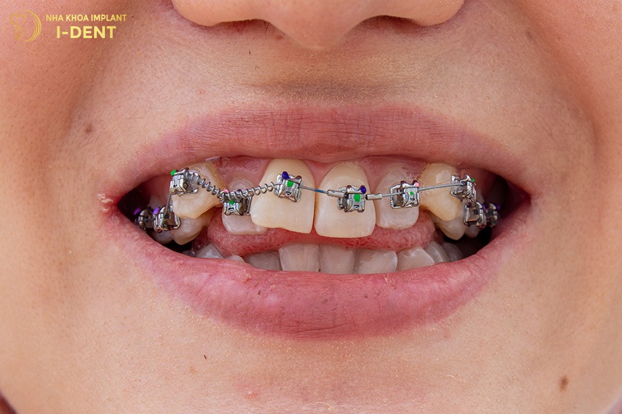 các phương pháp niềng răng hiện nay
