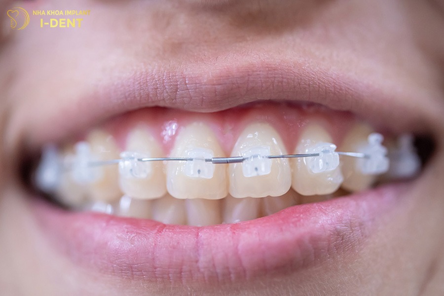 các phương pháp niềng răng tốt nhất