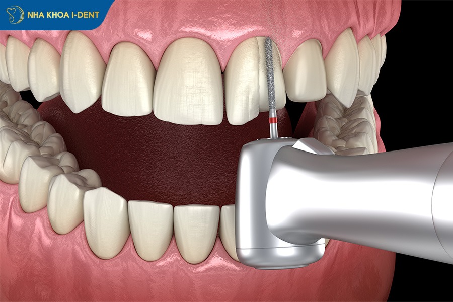 răng bọc sứ có niềng được không