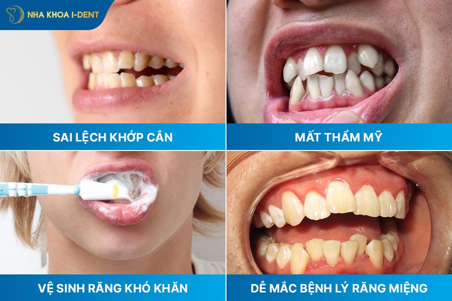 răng không đều có bọc sứ được không