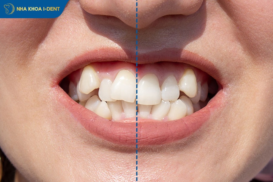 răng mọc lệch có bọc sứ được không