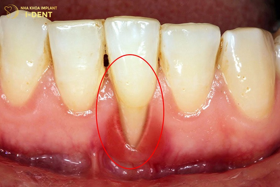 răng sứ có bị xuống màu không