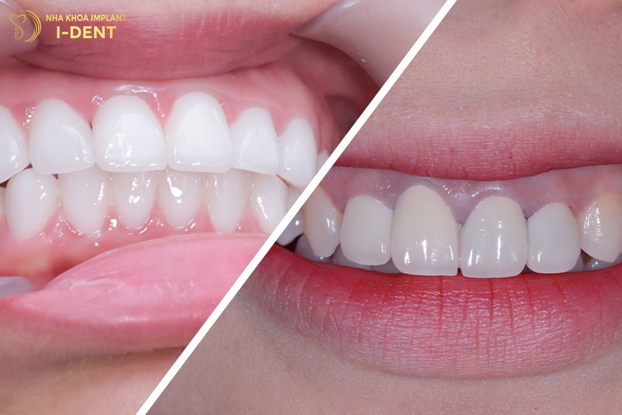 răng sứ có bị vàng không