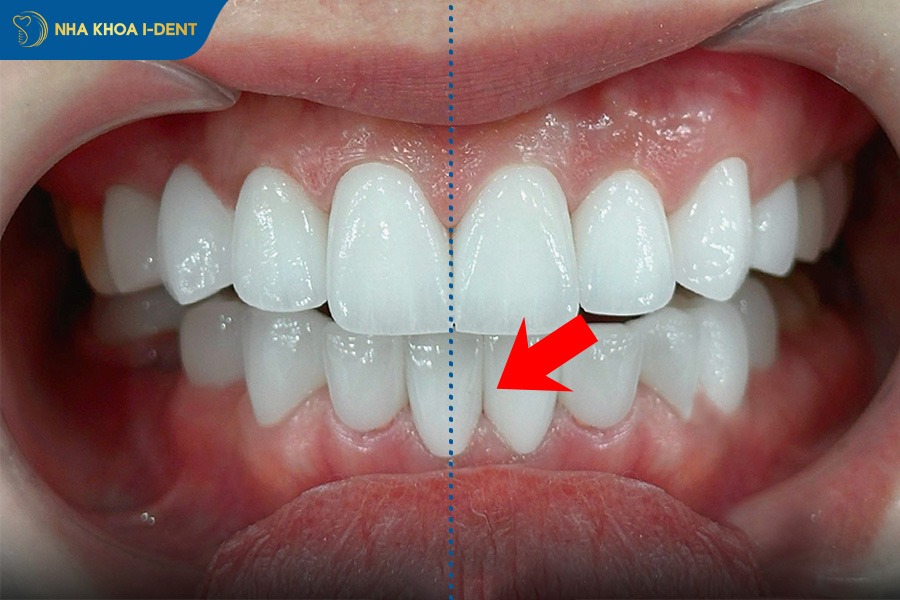 bọc răng sứ có niềng được không