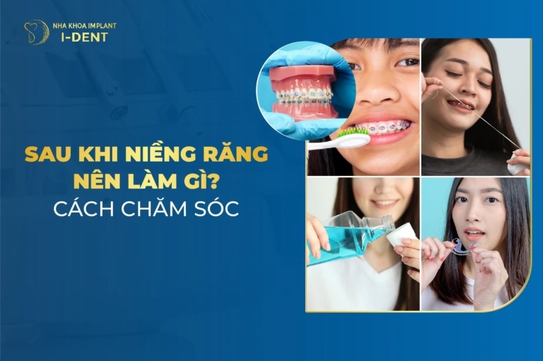 Sau Khi Niềng Răng Nên Làm Gì? Cách Chăm Sóc