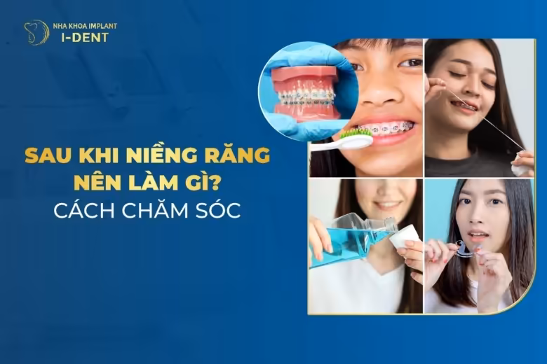 Sau Khi Niềng Răng Nên Làm Gì? Cách Chăm Sóc