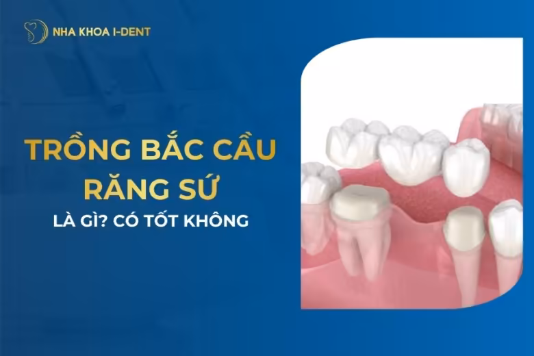 bắc cầu răng sứ