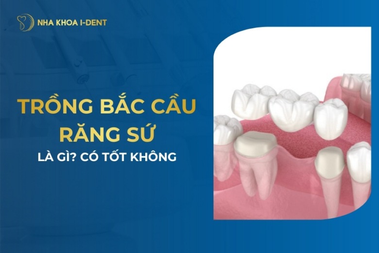 Trồng Răng Bắc Cầu Là Gì? Có Nên Làm Răng Bắc Cầu?