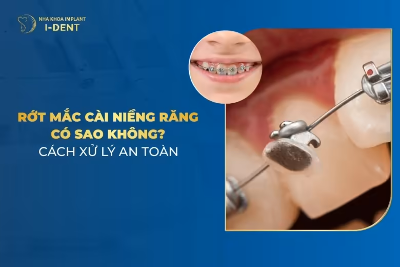 Rớt Mắc Cài Niềng Răng Có Sao Không? Cách Xử Lý An Toàn