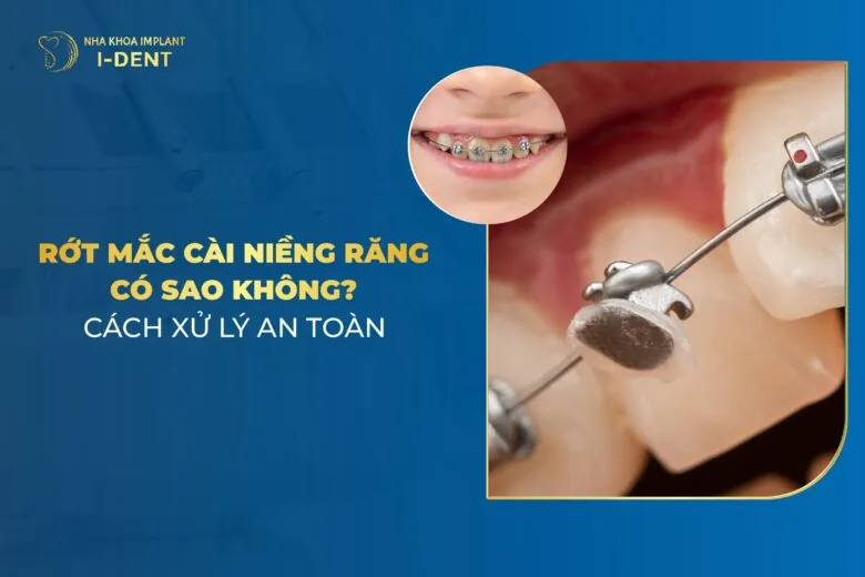 Rớt Mắc Cài Niềng Răng Có Sao Không? Cách Xử Lý An Toàn