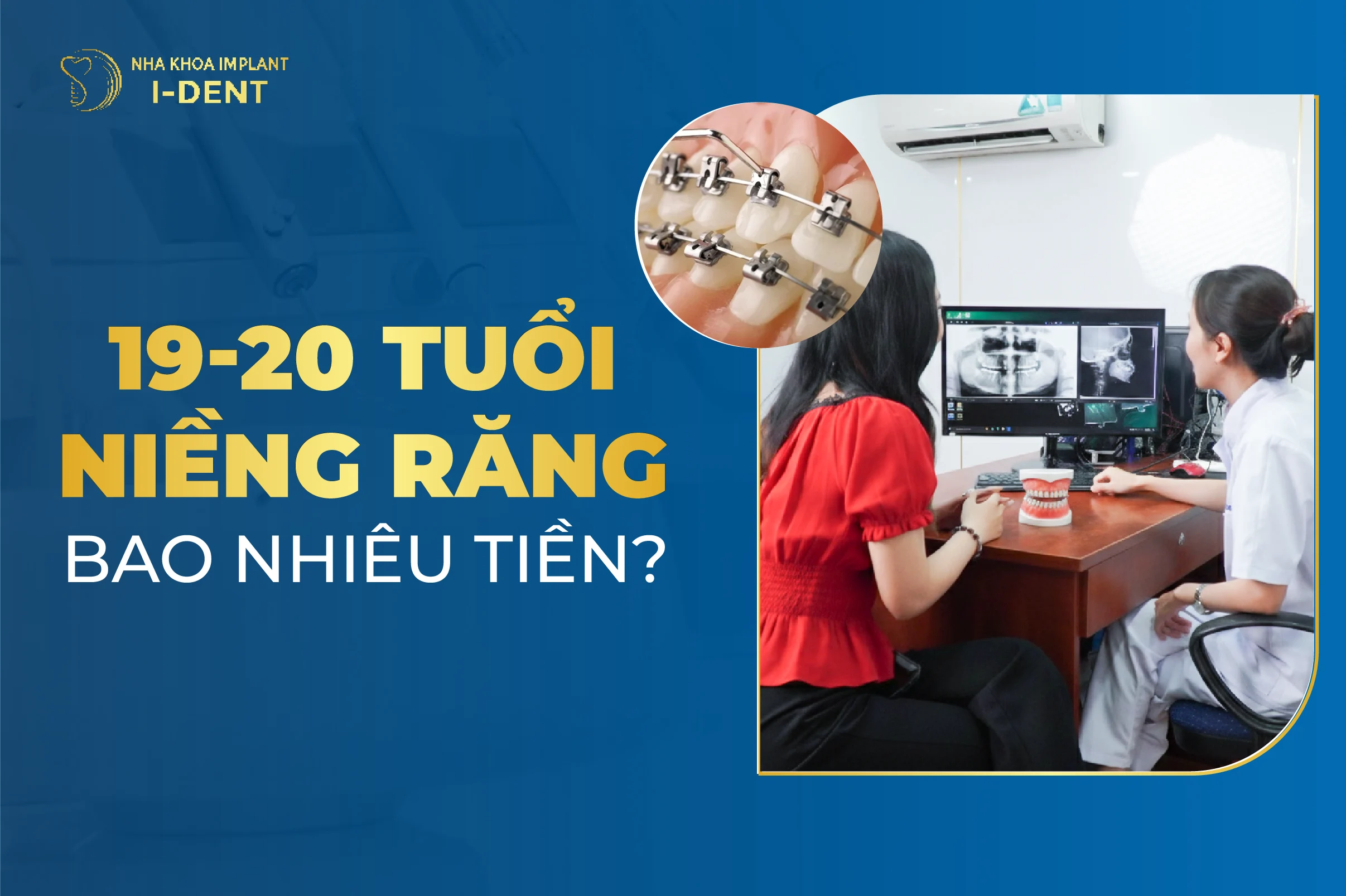 19-20 Tuổi Niềng Răng Bao Nhiêu Tiền? Mất Bao Lâu?