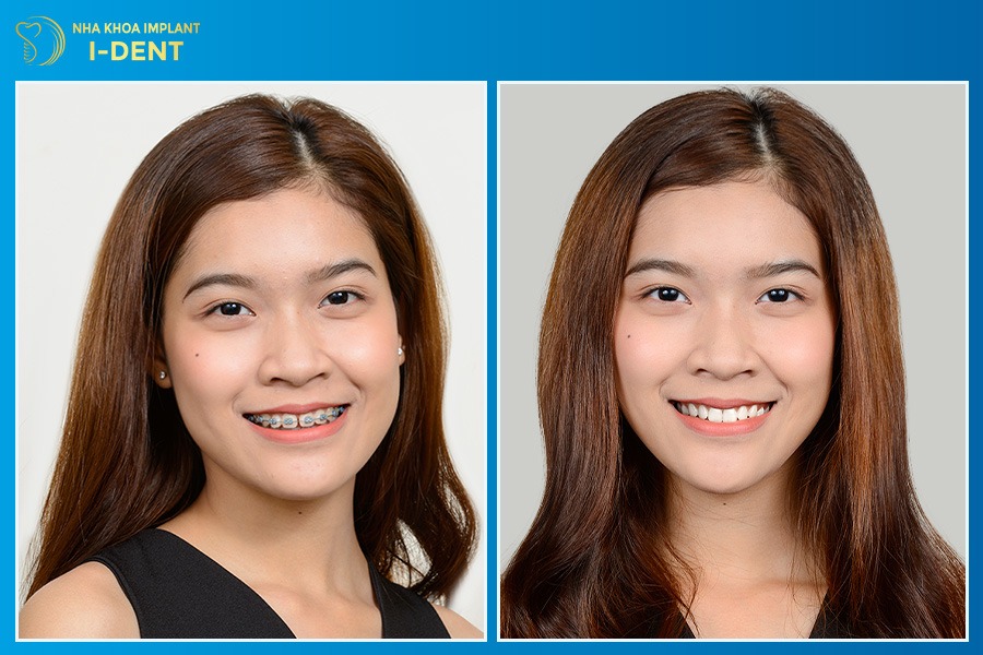 24-28 tuổi niềng răng có thể thực hiện được