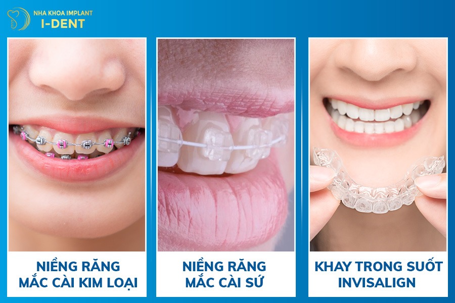 3 phương pháp niềng răng cho người 24 - 28 tuổi