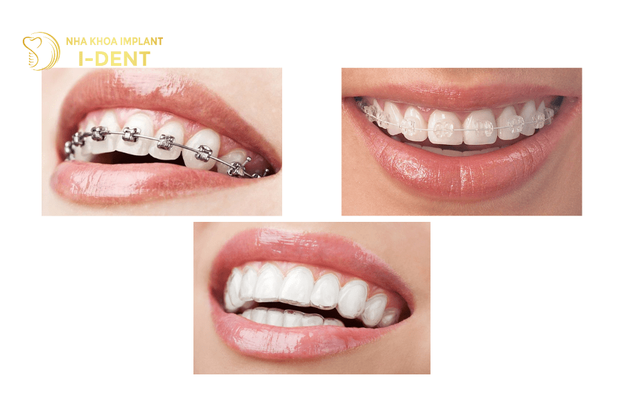 3 phương pháp niềng răng cho trẻ 14 tuổi