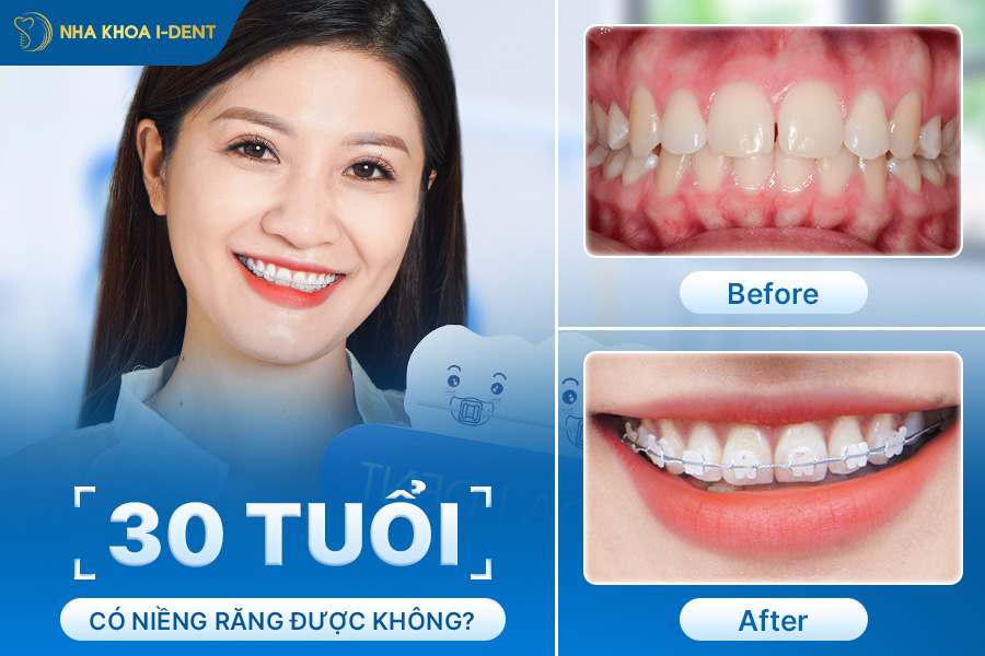 30 tuổi có niềng răng được không - Nha khoa I-Dent