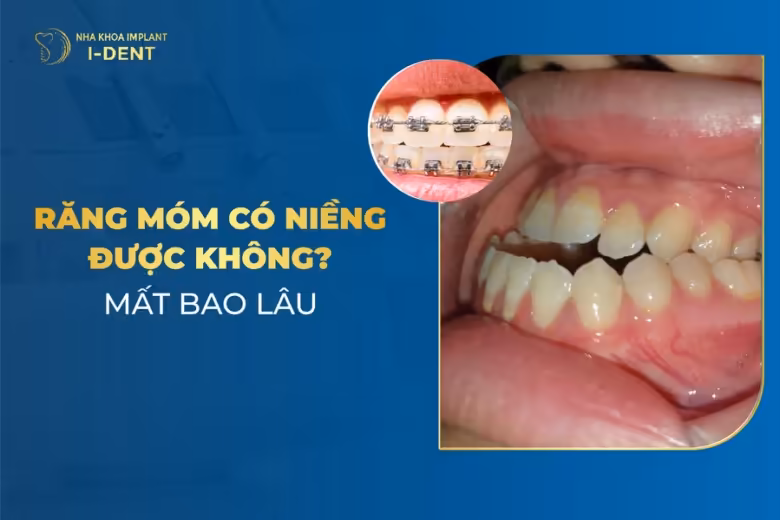 bị móm có niềng răng được không