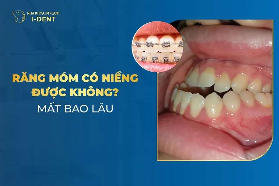 bị móm có niềng răng được không