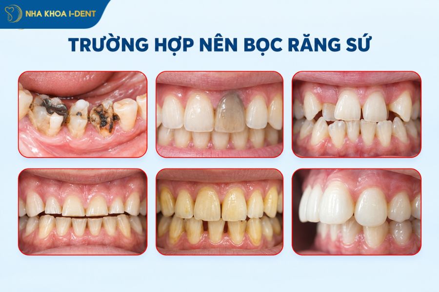 bọc răng sứ thẩm mỹ
