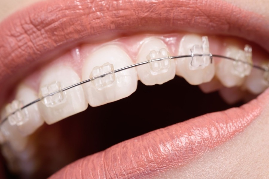 các loại niềng răng mắc cài sứ