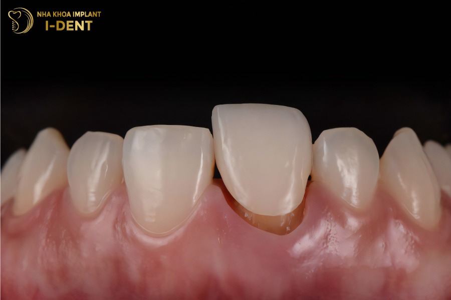 răng sứ có bị ố vàng không