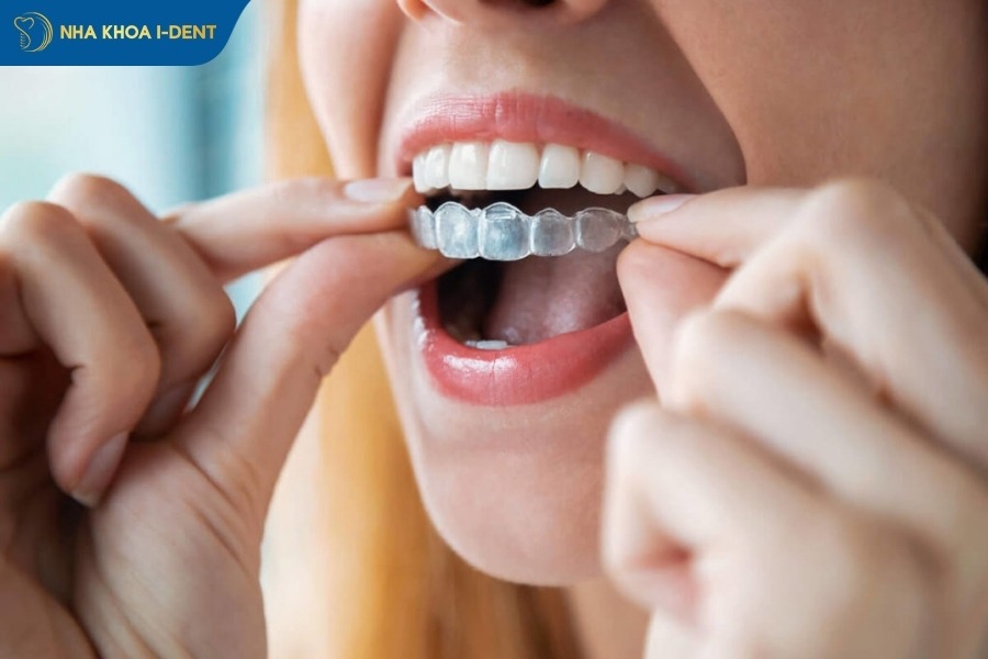 chi phí niềng răng trong suốt