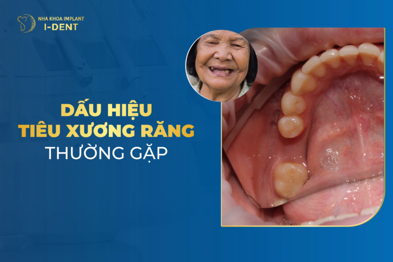 dấu hiệu tiêu xương răng